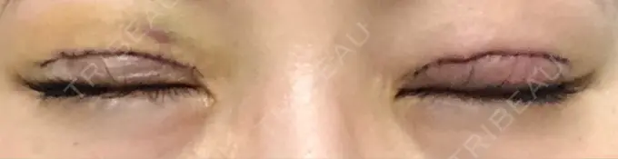 二重切開 城本クリニック 福岡院 DAY 5 メイン用