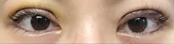 二重切開 城本クリニック 福岡院 AFTER メイン用