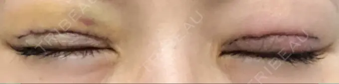 二重切開 城本クリニック 福岡院 DAY 6 メイン用