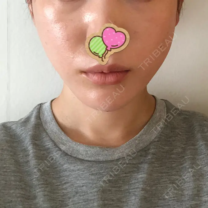 糸リフト / ヒアルロン酸注入（あご） / ボトックス（エラ・小顔） / 脂肪溶解注射（顔） 大阪TAクリニック DAY 0 メイン用