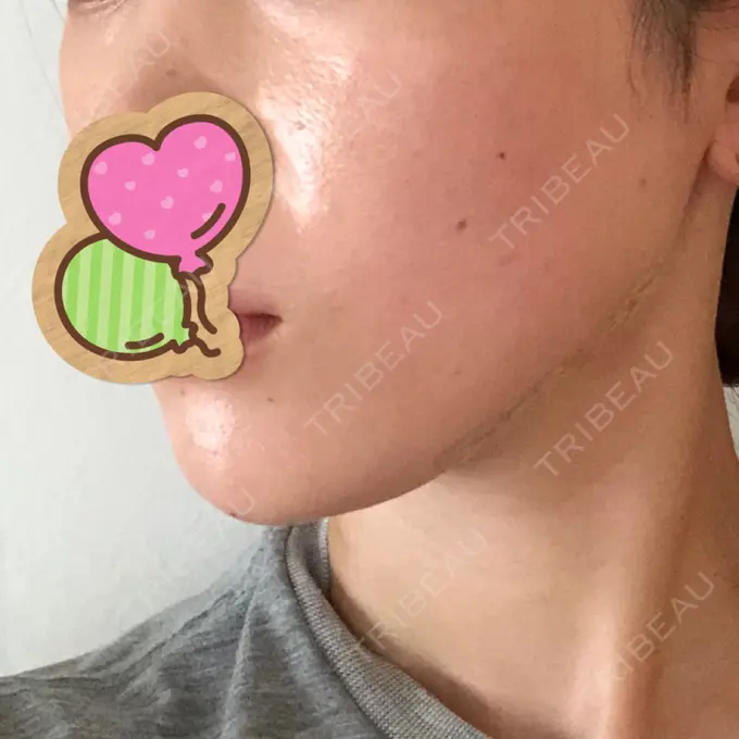 糸リフト / ヒアルロン酸注入（あご） / ボトックス（エラ・小顔） / 脂肪溶解注射（顔） 大阪TAクリニック DAY 0 メイン用