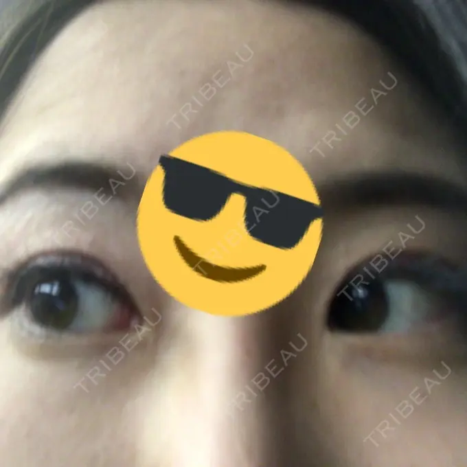 眼瞼下垂（切開） 船橋中央クリニック DAY 11 メイン用