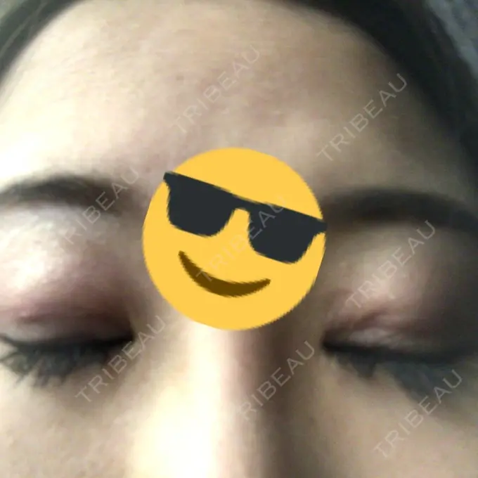 眼瞼下垂（切開） 船橋中央クリニック DAY 11 メイン用