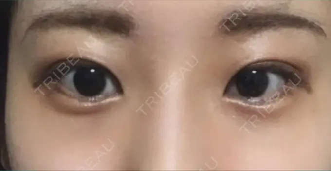 目尻切開 / タレ目形成・グラマラスライン（切開） A CLINIC（エークリニック） 銀座院 DAY 21 メイン用