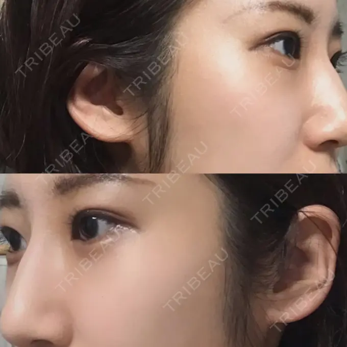 目尻切開 / タレ目形成・グラマラスライン（切開） A CLINIC（エークリニック） 銀座院 DAY 21 メイン用