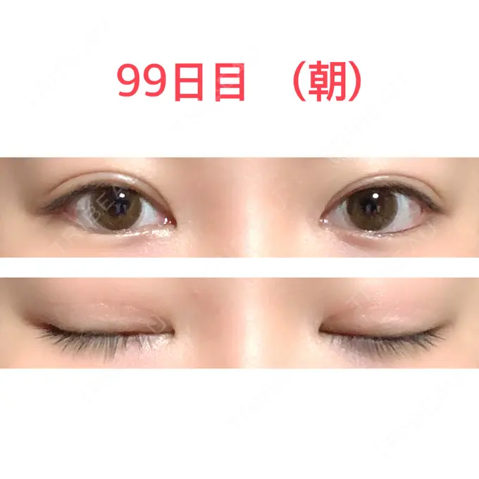 二重切開 水の森美容クリニック 東京新宿院 AFTER メイン用