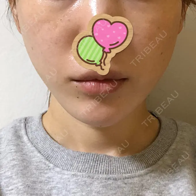 糸リフト / ヒアルロン酸注入（あご） / ボトックス（エラ・小顔） / 脂肪溶解注射（顔） 大阪TAクリニック DAY 3 メイン用