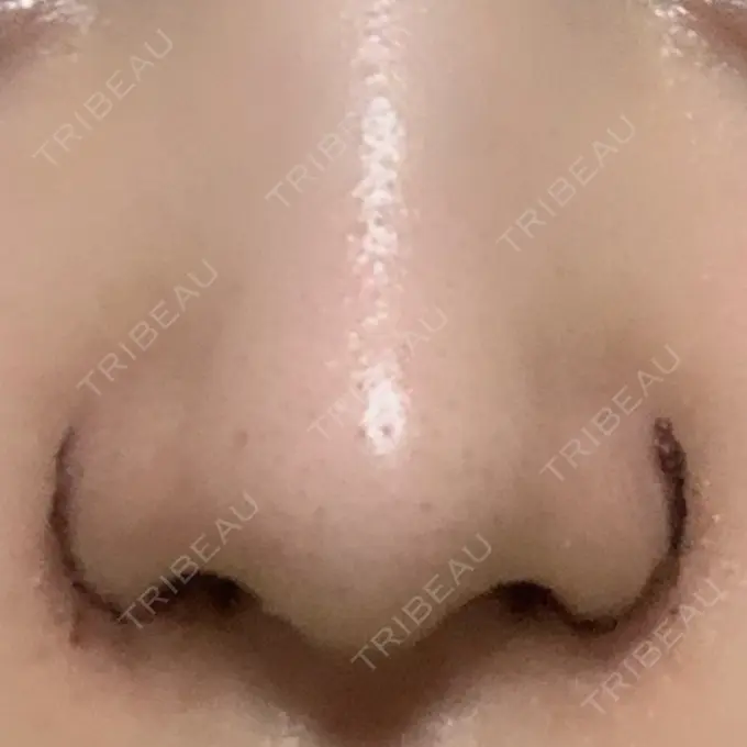 小鼻縮小（切開） / 鼻翼挙上 東京形成美容外科 船橋院 DAY 4 メイン用