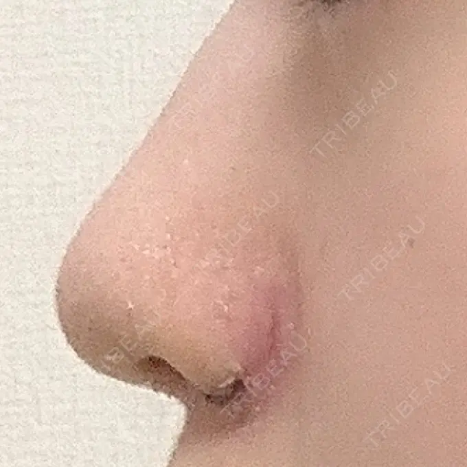 小鼻縮小（切開） / 鼻翼挙上 東京形成美容外科 船橋院 DAY 5 メイン用