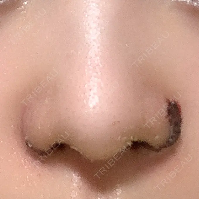 小鼻縮小（切開） / 鼻翼挙上 東京形成美容外科 船橋院 DAY 5 メイン用