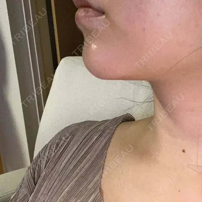 ヒアルロン酸注入（あご） TCB東京中央美容外科 池袋西口院 DAY 227 メイン用