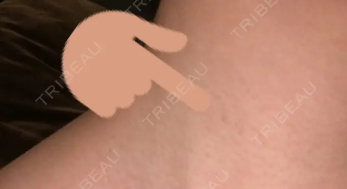 ほくろ・いぼ切除（肌） 医療法人美彩会 グランクリニック AFTER メイン用