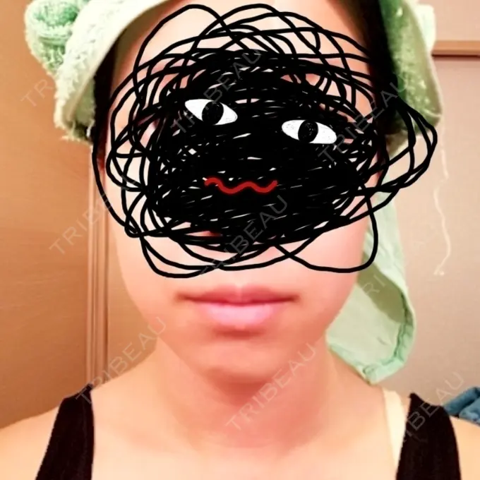 脂肪溶解注射（顔） 新宿美容外科クリニック 新宿院 DAY 14 メイン用