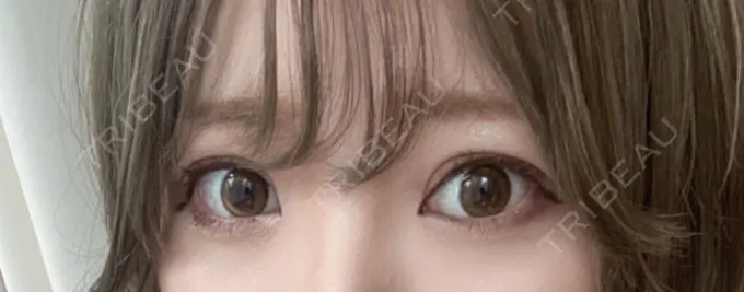 眼瞼下垂（切開） / 上まぶたの脂肪取り なでしこクリニック AFTER メイン用