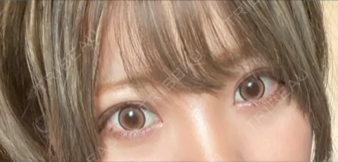 眼瞼下垂（切開） / 上まぶたの脂肪取り なでしこクリニック DAY 369 メイン用