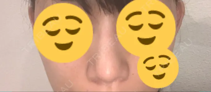 鼻尖形成（切開） / 軟骨移植 THE ROPPONGI CLINIC（ザ 六本木クリニック） DAY 30 メイン用