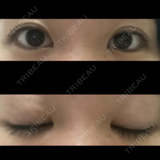 二重埋没 東京形成美容外科 船橋院 AFTER メイン用