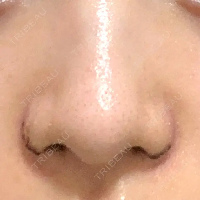 小鼻縮小（切開） / 鼻翼挙上 東京形成美容外科 船橋院 DAY 7 メイン用