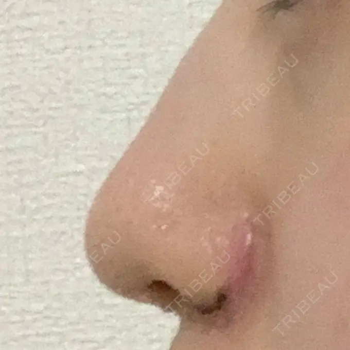 小鼻縮小（切開） / 鼻翼挙上 東京形成美容外科 船橋院 DAY 7 メイン用