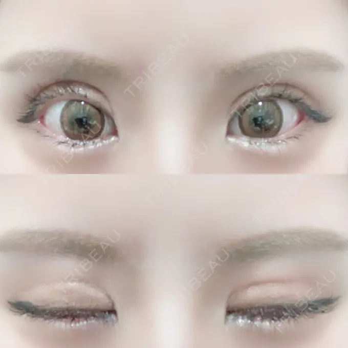 二重切開 / 目元修正 心斎橋コムロ美容外科クリニック DAY 164 メイン用