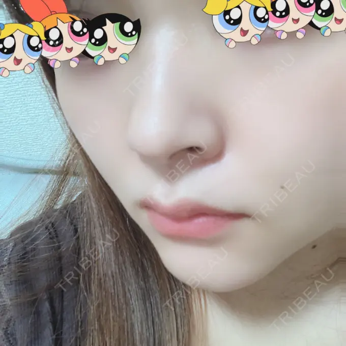 軟骨移植 BIANCA銀座 DAY 51 メイン用