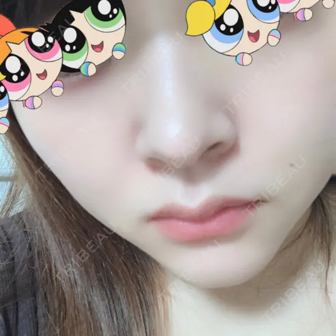 軟骨移植 BIANCA銀座 DAY 51 メイン用