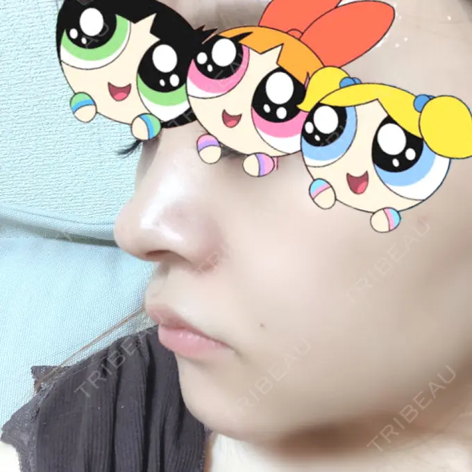 軟骨移植 BIANCA銀座 DAY 40 メイン用