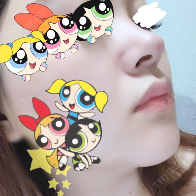 軟骨移植 BIANCA銀座 DAY 17 メイン用