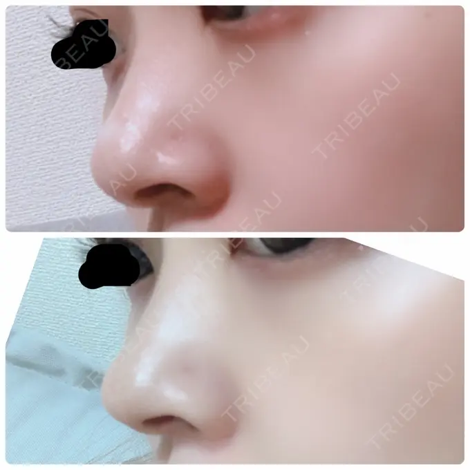 軟骨移植 BIANCA銀座 DAY 50 メイン用