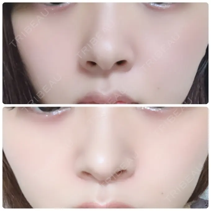 軟骨移植 BIANCA銀座 DAY 50 メイン用