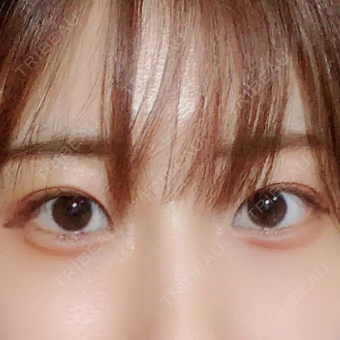 目尻切開 / タレ目形成・グラマラスライン（切開） A CLINIC（エークリニック） 銀座院 AFTER メイン用