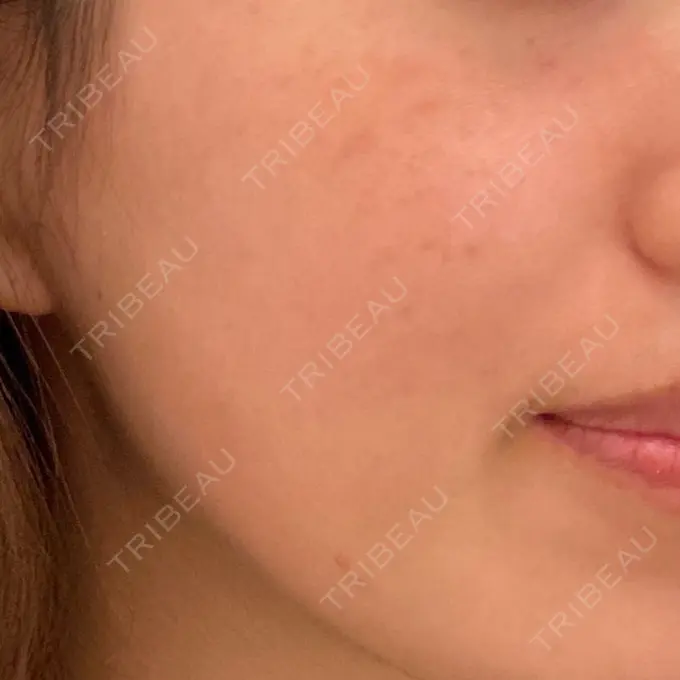 その他（肌） / ダーマペン A CLINIC（エークリニック） 横浜院 AFTER メイン用