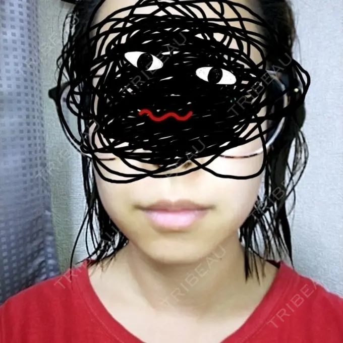 脂肪溶解注射（顔） 新宿美容外科クリニック 新宿院 AFTER メイン用