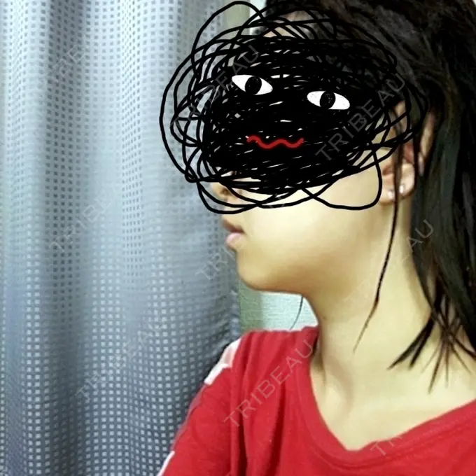 脂肪溶解注射（顔） 新宿美容外科クリニック 新宿院 DAY 14 メイン用