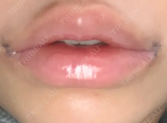 口角挙上 新宿ラクル美容外科クリニック 新宿院 DAY 4 メイン用