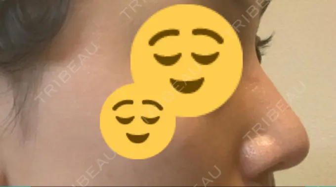 鼻尖形成（切開） / 軟骨移植 THE ROPPONGI CLINIC（ザ 六本木クリニック） DAY 35 メイン用