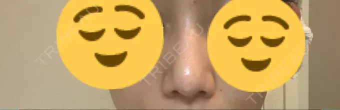 鼻尖形成（切開） / 軟骨移植 THE ROPPONGI CLINIC（ザ 六本木クリニック） DAY 35 メイン用