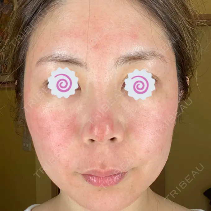 ダーマペン 品川美容外科 品川院 DAY 2 メイン用