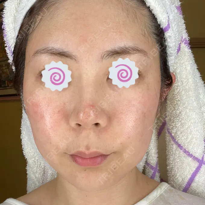 ダーマペン 品川美容外科 品川院 DAY 4 メイン用