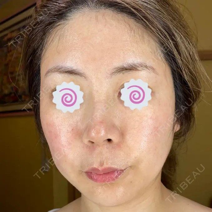 ダーマペン 品川美容外科 品川院 DAY 5 メイン用