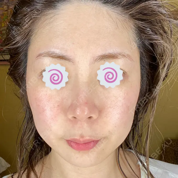 ダーマペン 品川美容外科 品川院 AFTER メイン用