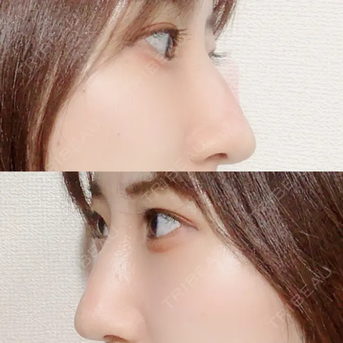 目尻切開 / タレ目形成・グラマラスライン（切開） A CLINIC（エークリニック） 銀座院 DAY 30 メイン用