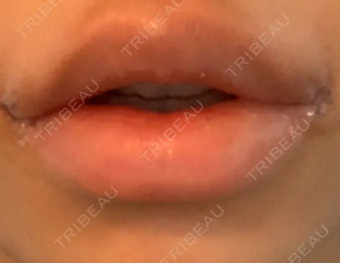 口角挙上 新宿ラクル美容外科クリニック 新宿院 DAY 5 メイン用