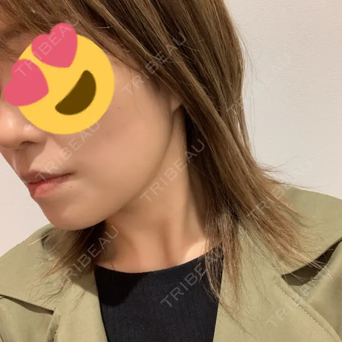 糸リフト / バッカルファット除去 / 脂肪吸引（顔） / メーラーファット除去 / ボトックス（エラ・小顔） 湘南美容クリニック 秋葉原院 DAY -67 メイン用