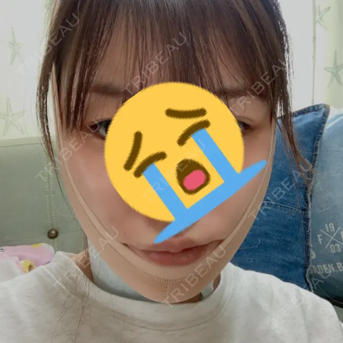 糸リフト / バッカルファット除去 / 脂肪吸引（顔） / メーラーファット除去 / ボトックス（エラ・小顔） 湘南美容クリニック 秋葉原院 DAY -95 メイン用