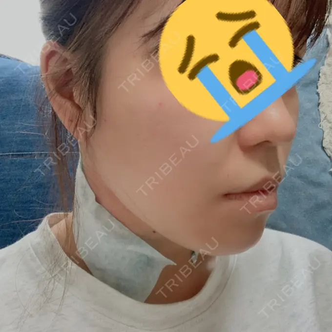 糸リフト / バッカルファット除去 / 脂肪吸引（顔） / メーラーファット除去 / ボトックス（エラ・小顔） 湘南美容クリニック 秋葉原院 DAY -95 メイン用