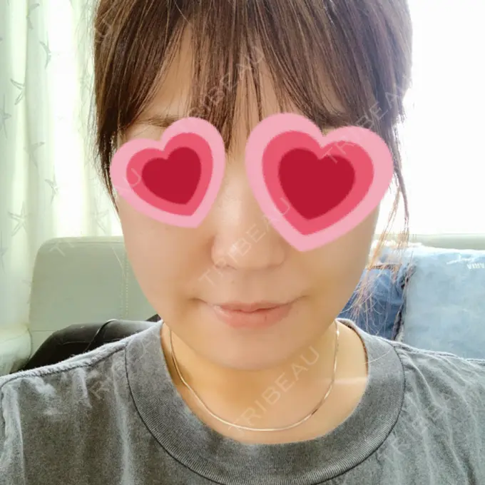 糸リフト / バッカルファット除去 / 脂肪吸引（顔） / メーラーファット除去 / ボトックス（エラ・小顔） 湘南美容クリニック 秋葉原院 DAY -92 メイン用