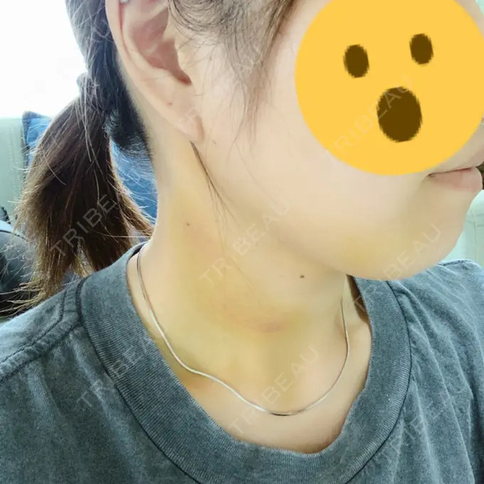 糸リフト / バッカルファット除去 / 脂肪吸引（顔） / メーラーファット除去 / ボトックス（エラ・小顔） 湘南美容クリニック 秋葉原院 DAY -92 メイン用