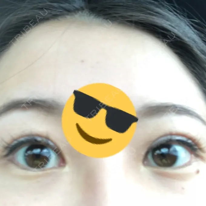 眼瞼下垂（切開） 船橋中央クリニック DAY 13 メイン用