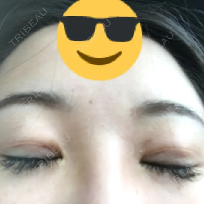 眼瞼下垂（切開） 船橋中央クリニック DAY 13 メイン用